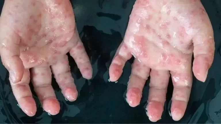 Monkeypox-virus